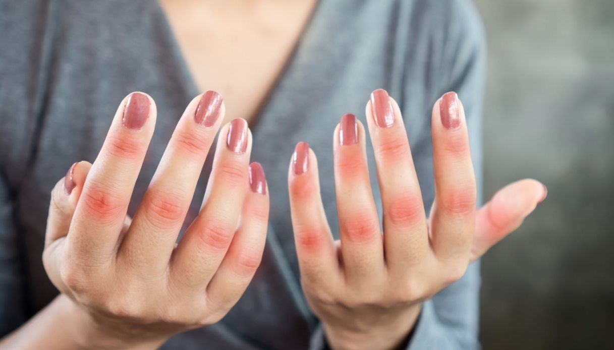 Artrite reumatoide: e se riuscissimo a curarla adesso senza farmaci?